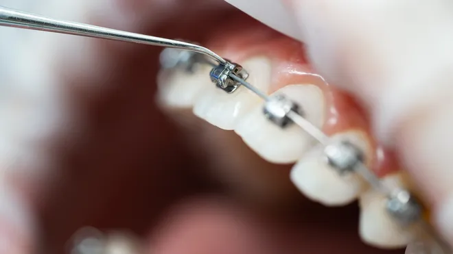 Wie hilft Kieferorthopädie Zuchwil bei Zahnproblemen?